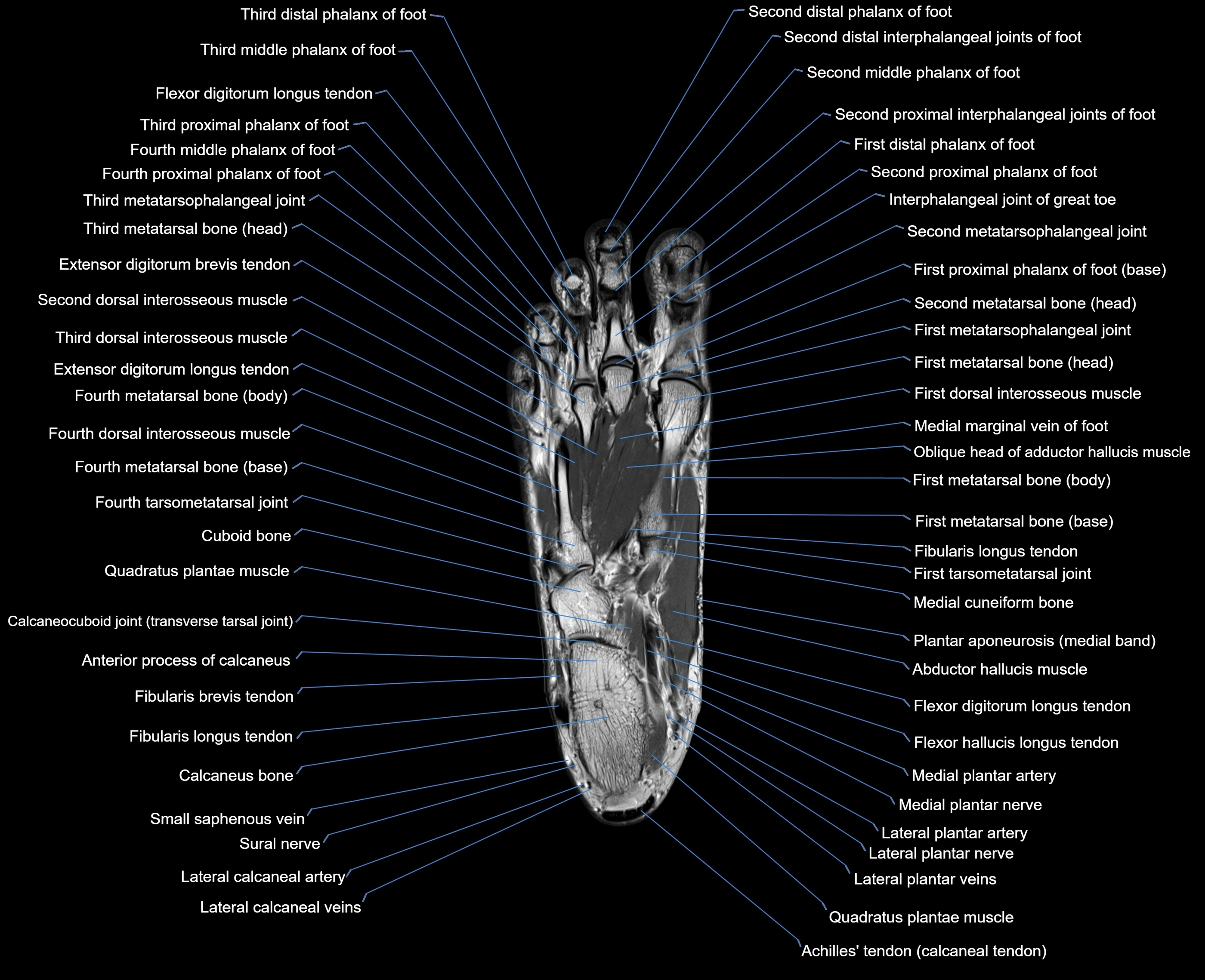 MRI foot coronal cross sectional anatomy 3T  radiology  image-img-00001-00021.webp